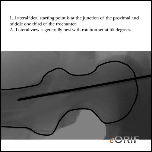 right intertrochanteric fracture icd 10